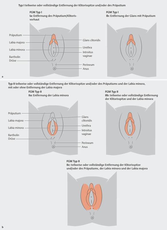 Schemazeichnungen zu den FGM/C-Typen I und II
