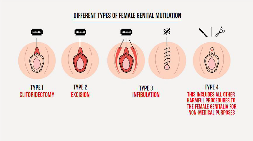 Übersicht über vier Typen von FGM/C